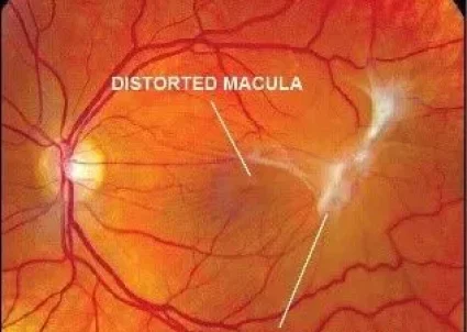 Epiretinal-membrane