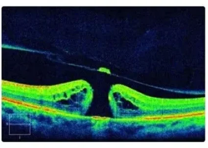 Macular-hole