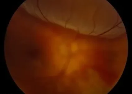 Retinal-Detachment