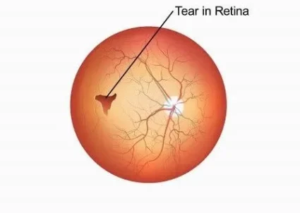 Retinal-Tear