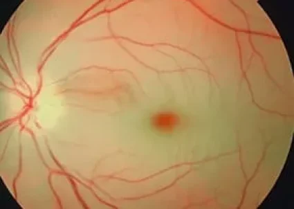 retinal-disorder-retinal-artery-occlusion
